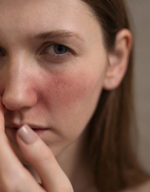 Laser Vascular la Clinica Roua – Tratează Capilarele Sparte și Varicele cu Precizie și Eficiență Laser Vascular la Clinica Roua - Tratează Capilarele Sparte și Varicele cu Precizie și Eficiență